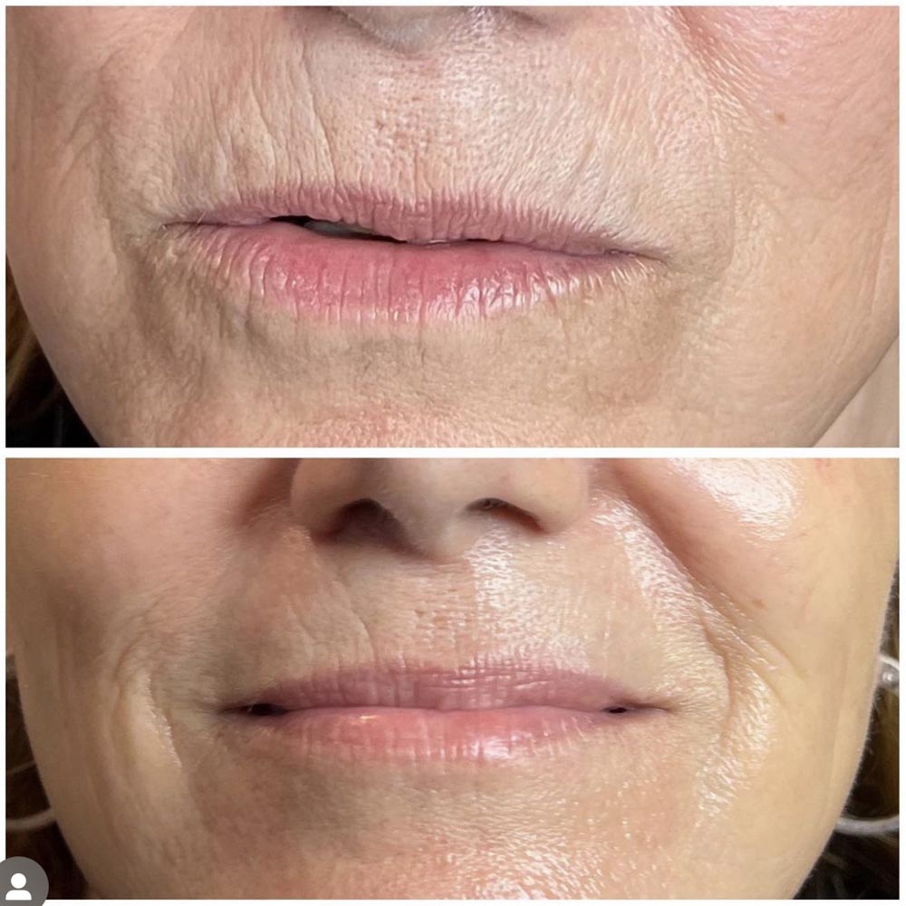 Age Jet Plasma Reviews Before And After