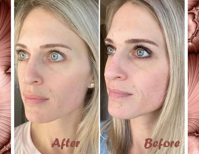 before and after of woman taking collagen supplements for skin, hair and nails