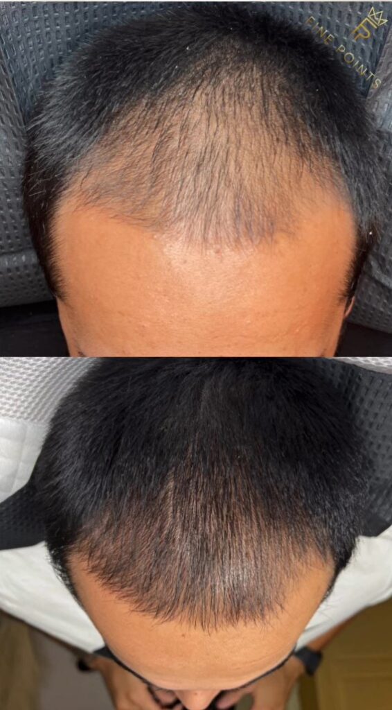 hair regrowth and restoration new jersey