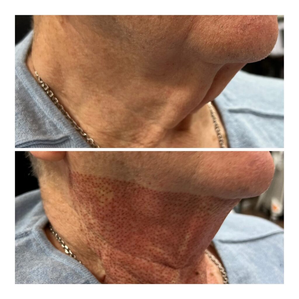 non surgical anti aging proceedure