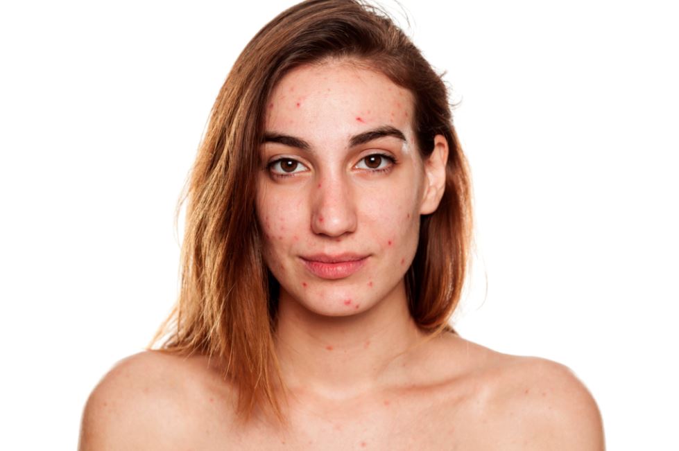 oily skin hormones acne barnegat nj
