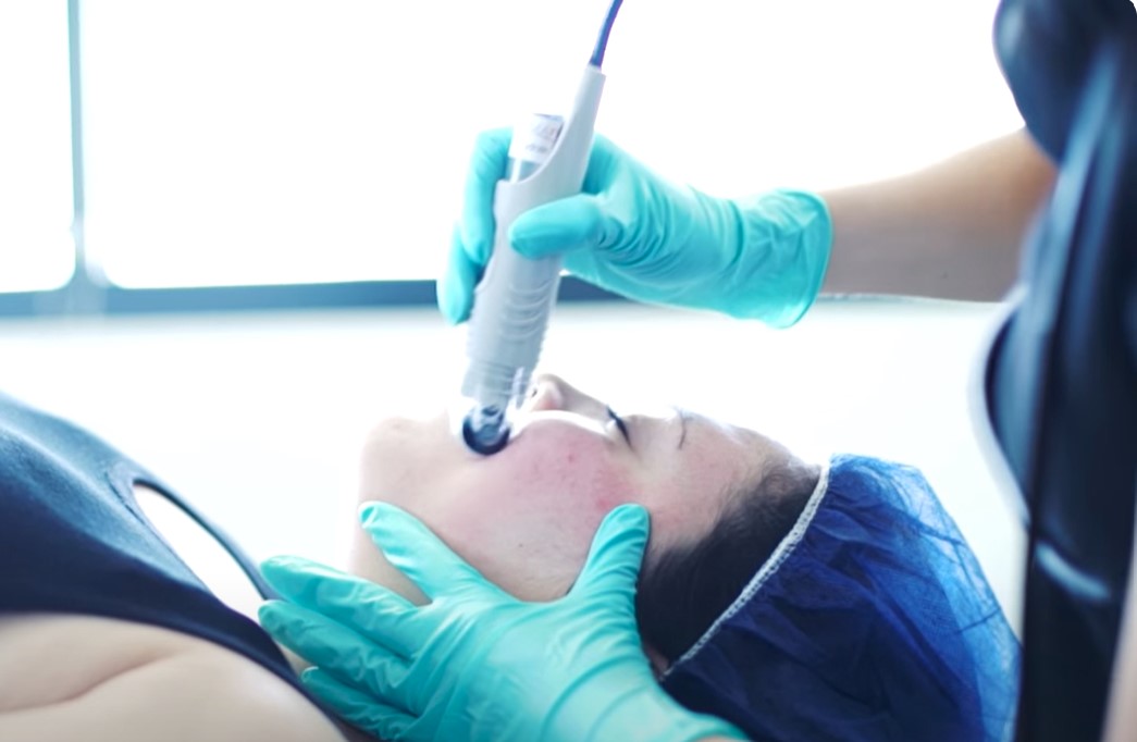 What Is A DermaFrac Skin Treatment and What Are The Skin Renewal Benefits?
