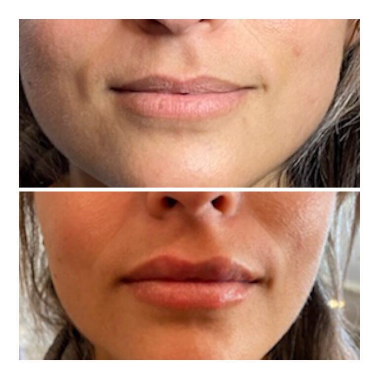 Needle Free Lip FIllerTry Needle Free Lip Fillers for Fuller Lips!