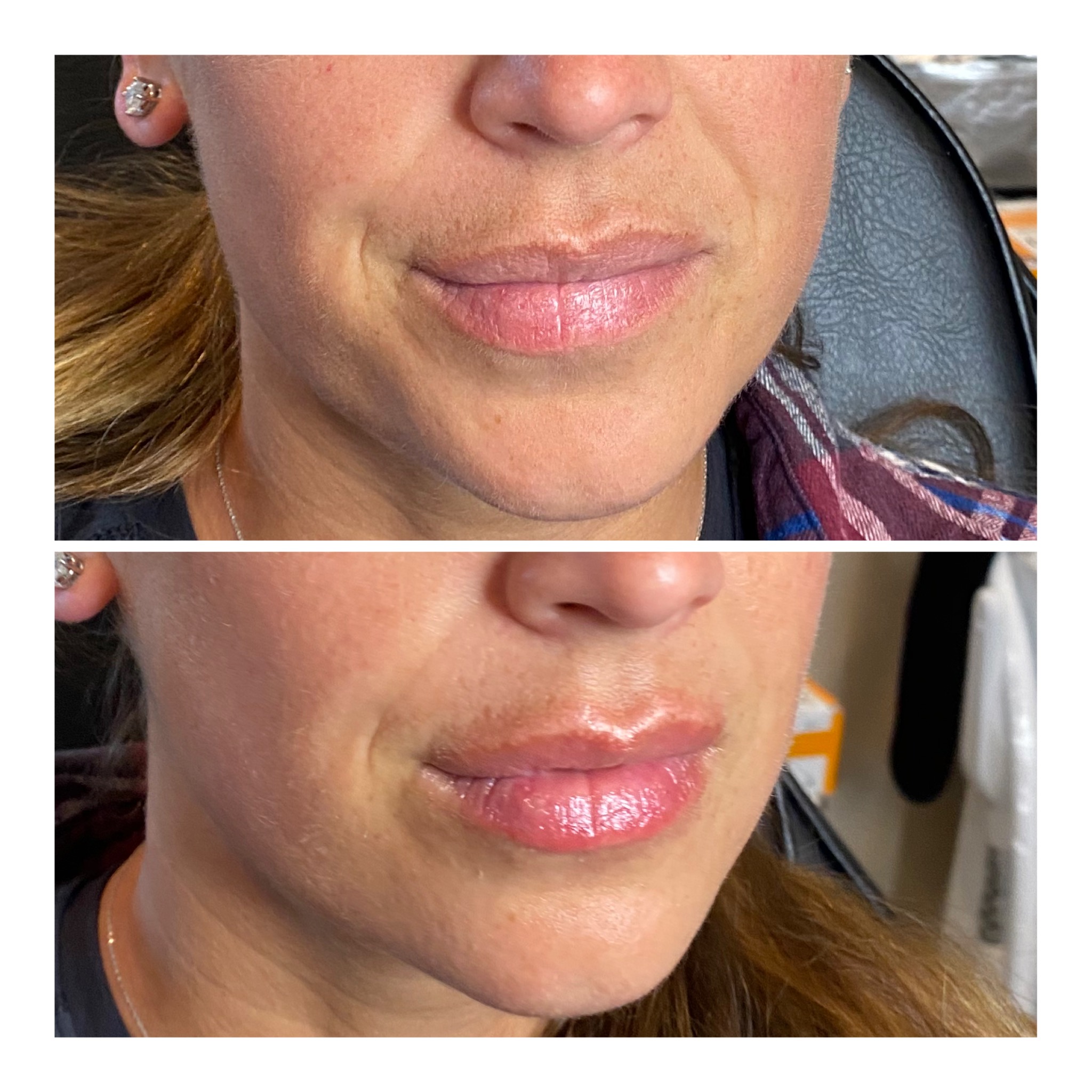 Needle Free Lip FIllerTry Needle Free Lip Fillers for Fuller Lips!