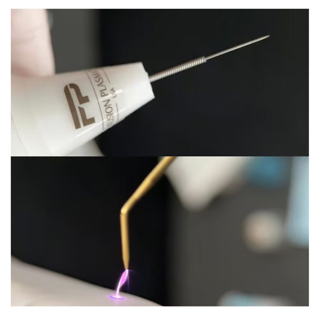 IMG_2463 warm plasma