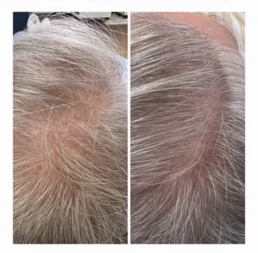 Client Hair Restoration at Ageless Aesthetics by HB Walsh