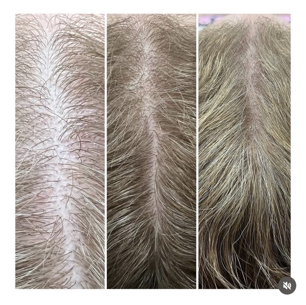 Hair Restoration Progress Photo Ageless Aesthetics by HB Walsh